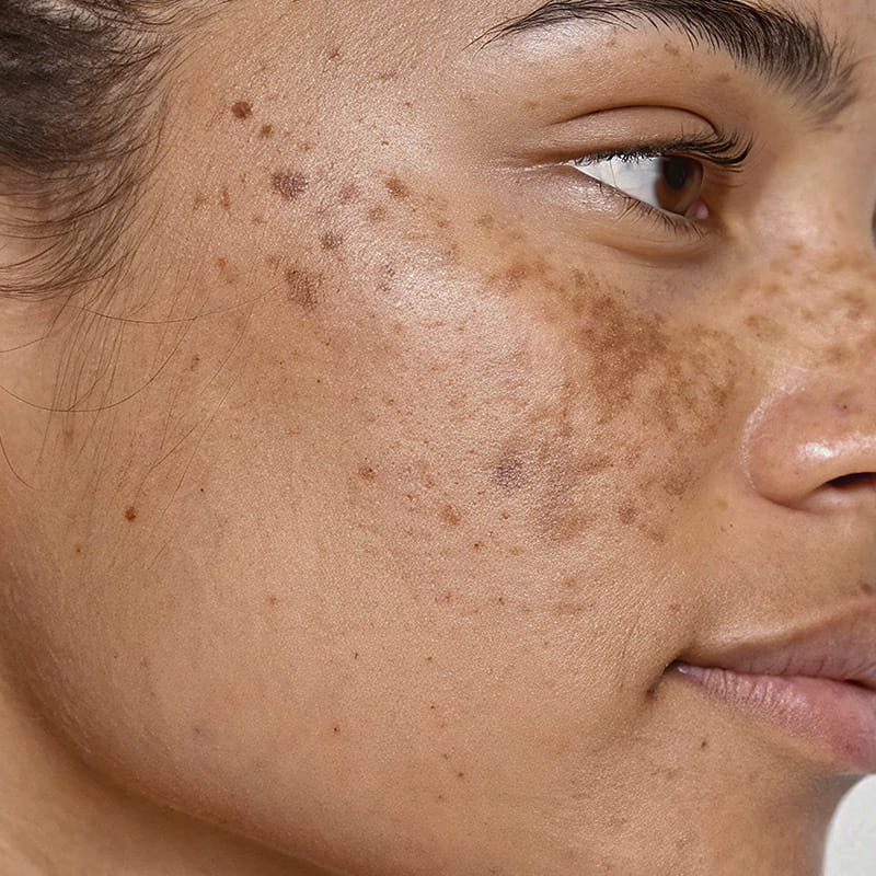 Hyperpigmentation
