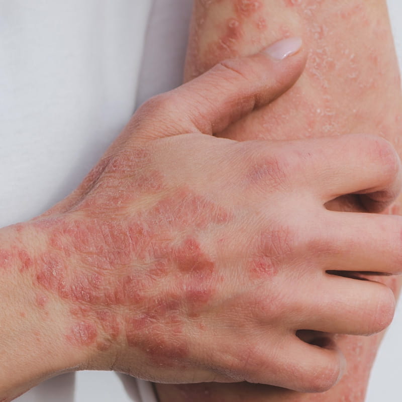 Psoriasis